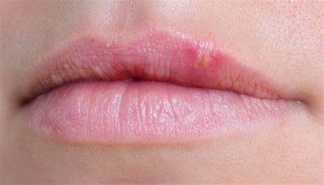 Bump on lip: Causes, treatment, and when to see a doctor