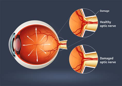 glaucoma optic nerve - Discovery Eye Foundation