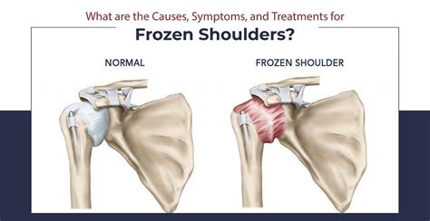 Causes, Symptoms, and Treatments for Frozen Shoulders | by Om Physio ...