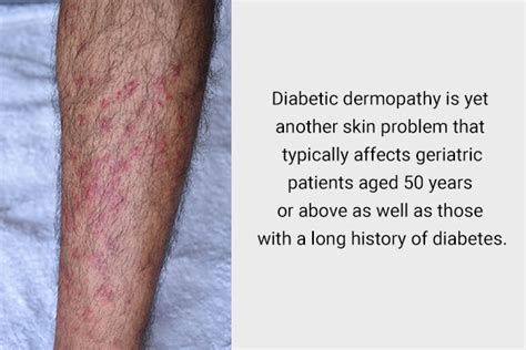 6 Skin Problems Associated With Diabetes - eMediHealth