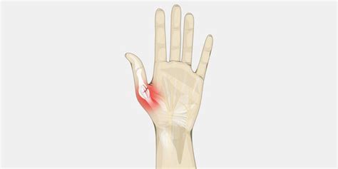 Sprained Thumb - The Complete Injury Guide - Vive Health