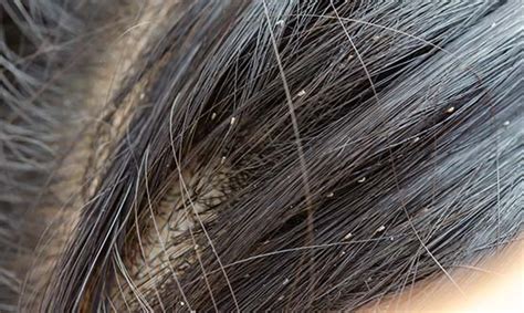 Outrageous Tips About How To Cure Head Lice - Feeloperation