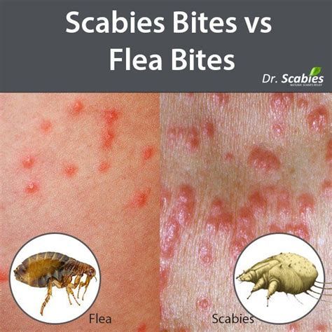 Scabies Bites Vs Bed Bug Bites – NBKomputer