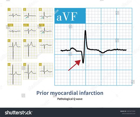 81 Pathological Q Wave Images, Stock Photos, 3D objects, & Vectors ...