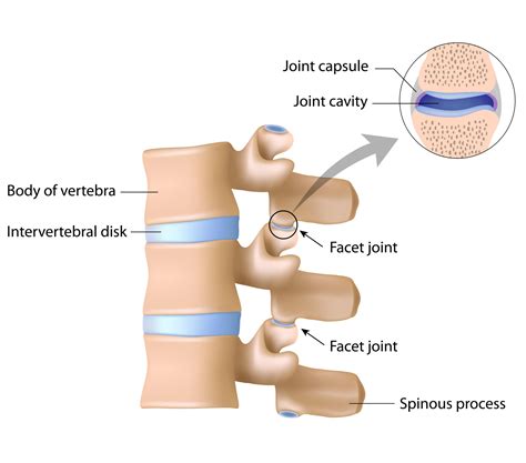 Facet Joint Syndrome | Pacific Sports & Spine