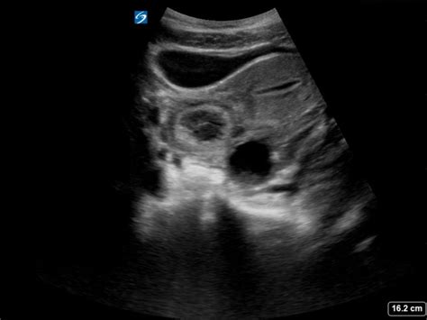 Tubo Ovarian Abscess On Ultrasound