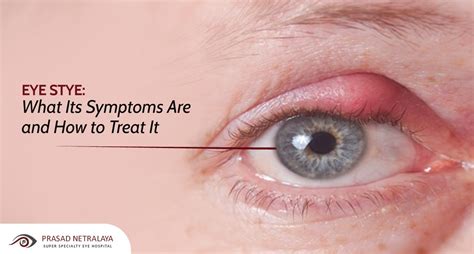 What Causes Styes In The Eye | Prasad Netralaya