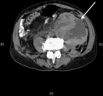 Retroperitoneal Hematoma - Medicalopedia