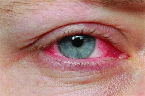 Pink eye, conjunctivitis, causes, symptoms, diagnosis & pink eye treatment