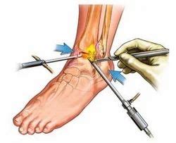 Ankle Arthroscopy Surgery Service in Kochi | ID: 17137696833