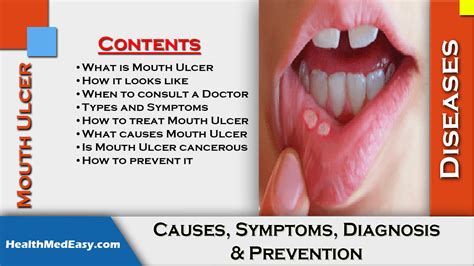 Mouth Ulcer - Causes, Symptoms, Diagnosis, Prevention - HealthMedEasy ...