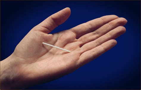 The Birth Control Implant | SexInfo Online