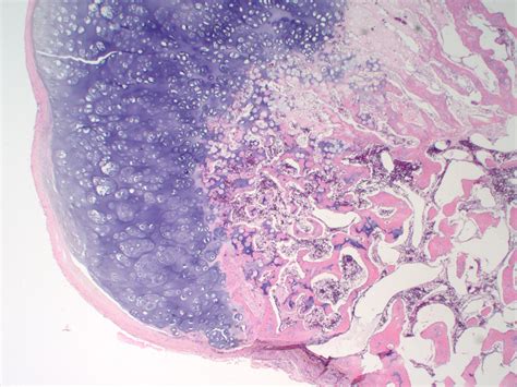 Osteochondroma pathophysiology - wikidoc