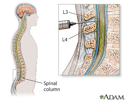 Cerebrospinal fluid (CSF) culture Information | Mount Sinai - New York