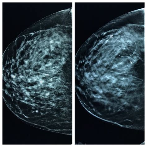 Breast Cancer Digital Mammogram