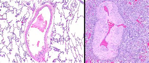 Pulmonary Artery Histology