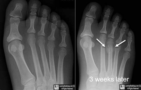 LearningRadiology - stress, fracture, march, foot