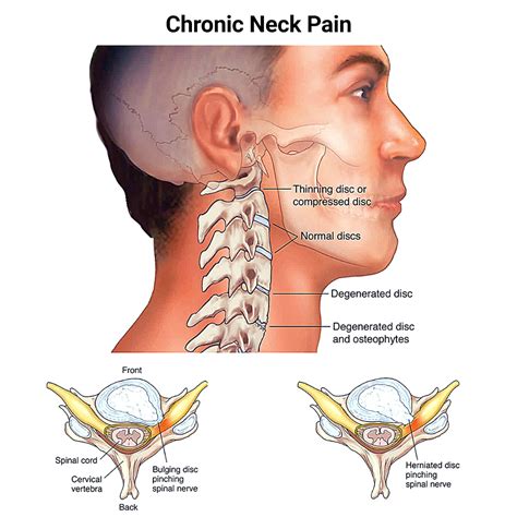 Why Chronic Neck Pain Should Never Be Ignored - NJ's Top Orthopedic ...