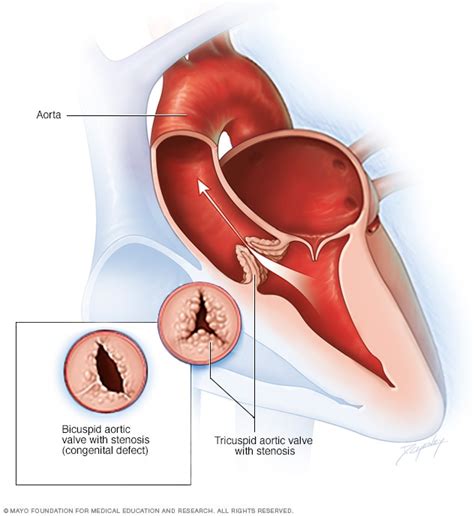 Estenosis de la válvula aórtica - Síntomas y causas - Mayo Clinic