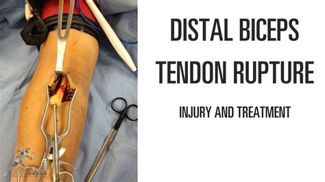 Distal Biceps Tendonitis