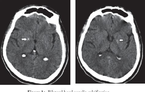 [Idiopathic bilateral basal ganglia calcification (Fahr's disease ...