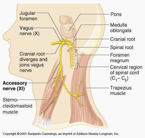 Cranial Nerve XI (Spinal Accessory Nerve) Deficit