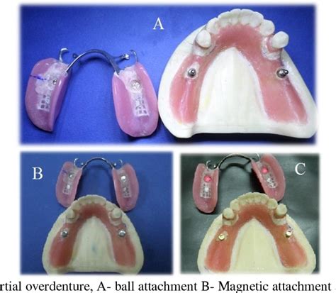 Kennedy Class 1 Rpd Design Mandibular