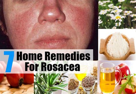 7 Amazing Rosacea Home Remedies and Treatments | Best Herbal Health