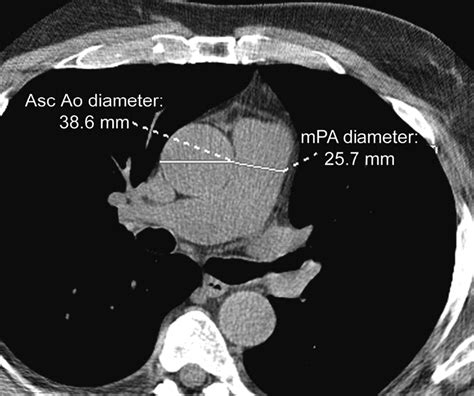 Reference Values for Normal Pulmonary Artery Dimensions by Noncontrast ...