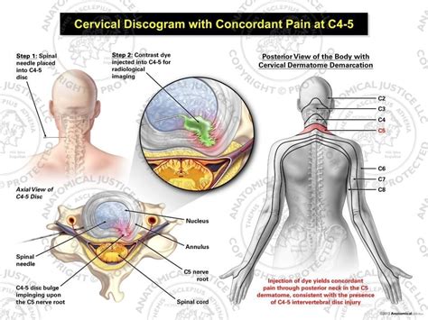 Female Left Cervical Discogram with Concordant Pain at C4-5