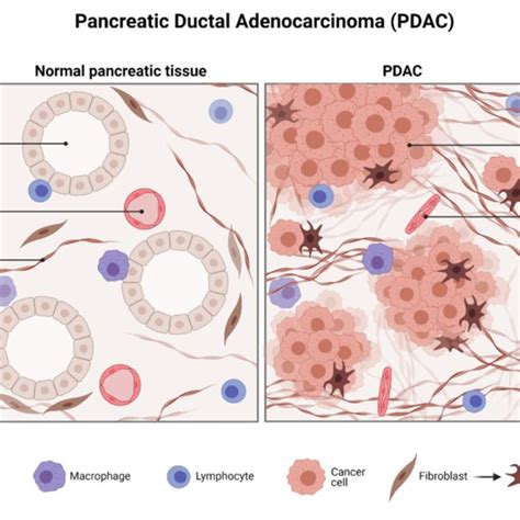 | Histology of pancreatic ductal adenocarcinoma. Created with ...