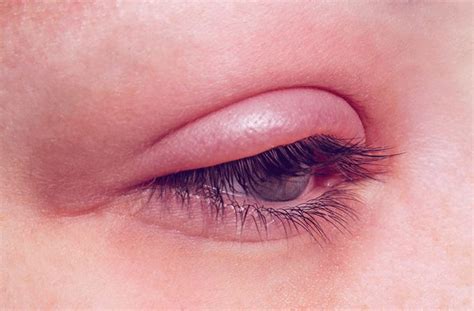 Eyelid Fungal Infection