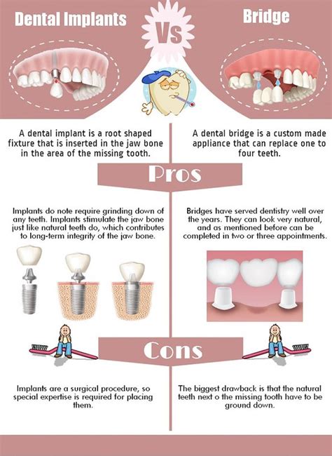 Implant Vs Bridge Pros And Cons - Best Image Viajeperu.org