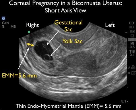 Ultrasound Leadership Academy: Ultrasound in Early Pregnancy — EM Curious