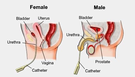 Urinary Catheterization Nursing Procedure & Management - Nurseslabs