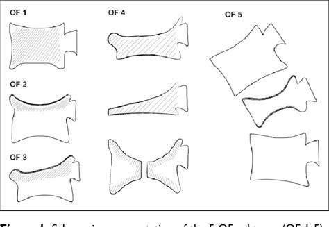 Figure 1 from Classification of Osteoporotic Thoracolumbar Spine ...