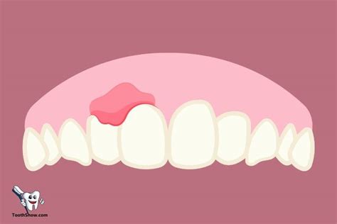 What Is An Abscess Tooth? : Causes, Symptoms, And Treatment