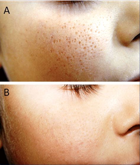 A) Patient before treatment: grouped, pitlike atrophic scars over the ...