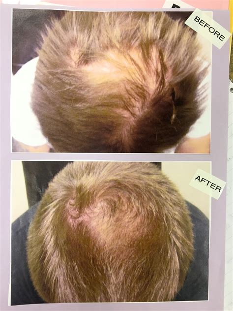 Laser Hair Growth Treatment Call for Free Consultation Las Vegas Reno