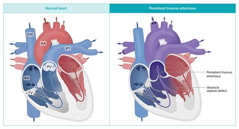 Congenital Heart Defects Symptoms