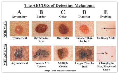 Melanoma- Get a Comprehensive Details about its Prevention