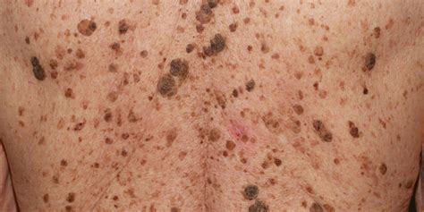 Got Mystery, Wart-Like Growths? They May Be Seborrheic Keratoses! - Dr ...