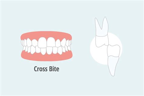 How To Fix a Crossbite: Causes and Treatment - Thurman Orthodontics