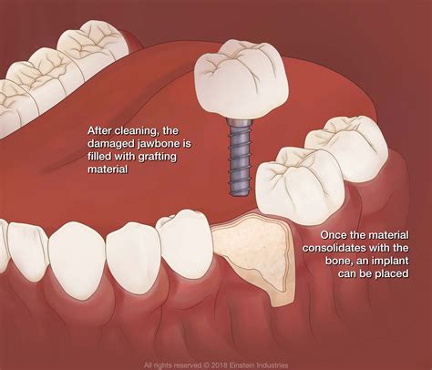 Bone Grafting - Los Algodones, Baja California - Dr. Valenzuela