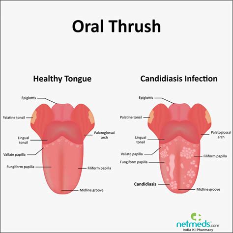 Oral Thrush - Causes, Symptoms And Treatment