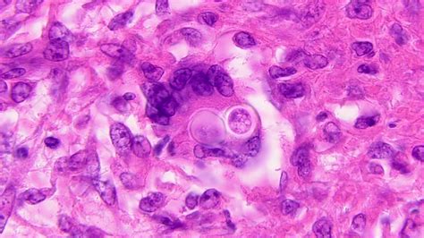 Blastomycosis Histology