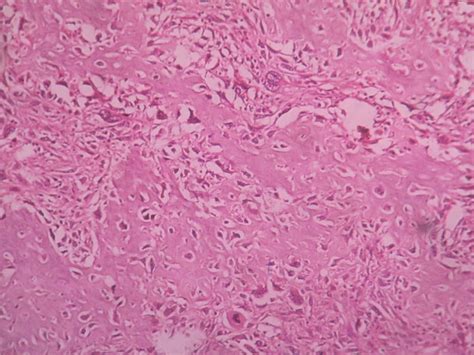 Chondrosarcoma 6 – Histopathology.guru