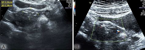 Sonography one month after the surgery: the myomectomy scar showed an ...