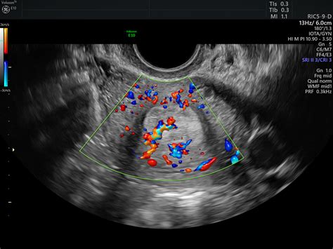 Using Color Doppler Ultrasound for Endometrial Pathology | Empowered ...