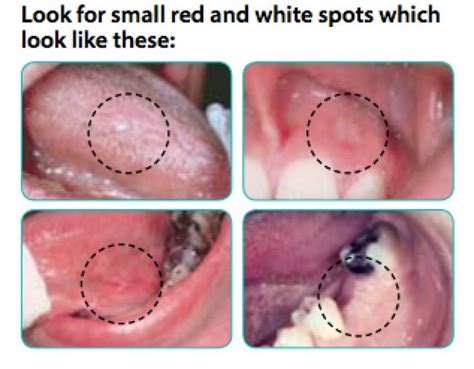 It's Oral Cancer Awareness Month: Have You Looked In Your Mouth Lately ...